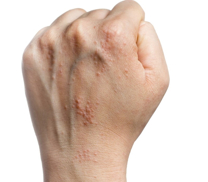 eczema por sol vörös foltok bukkantak fel a gyomorban